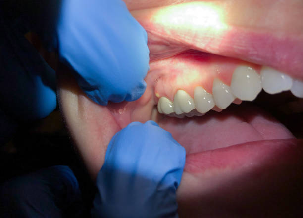 Best Emergency Wisdom Teeth Removal in Silver Springs, FL
